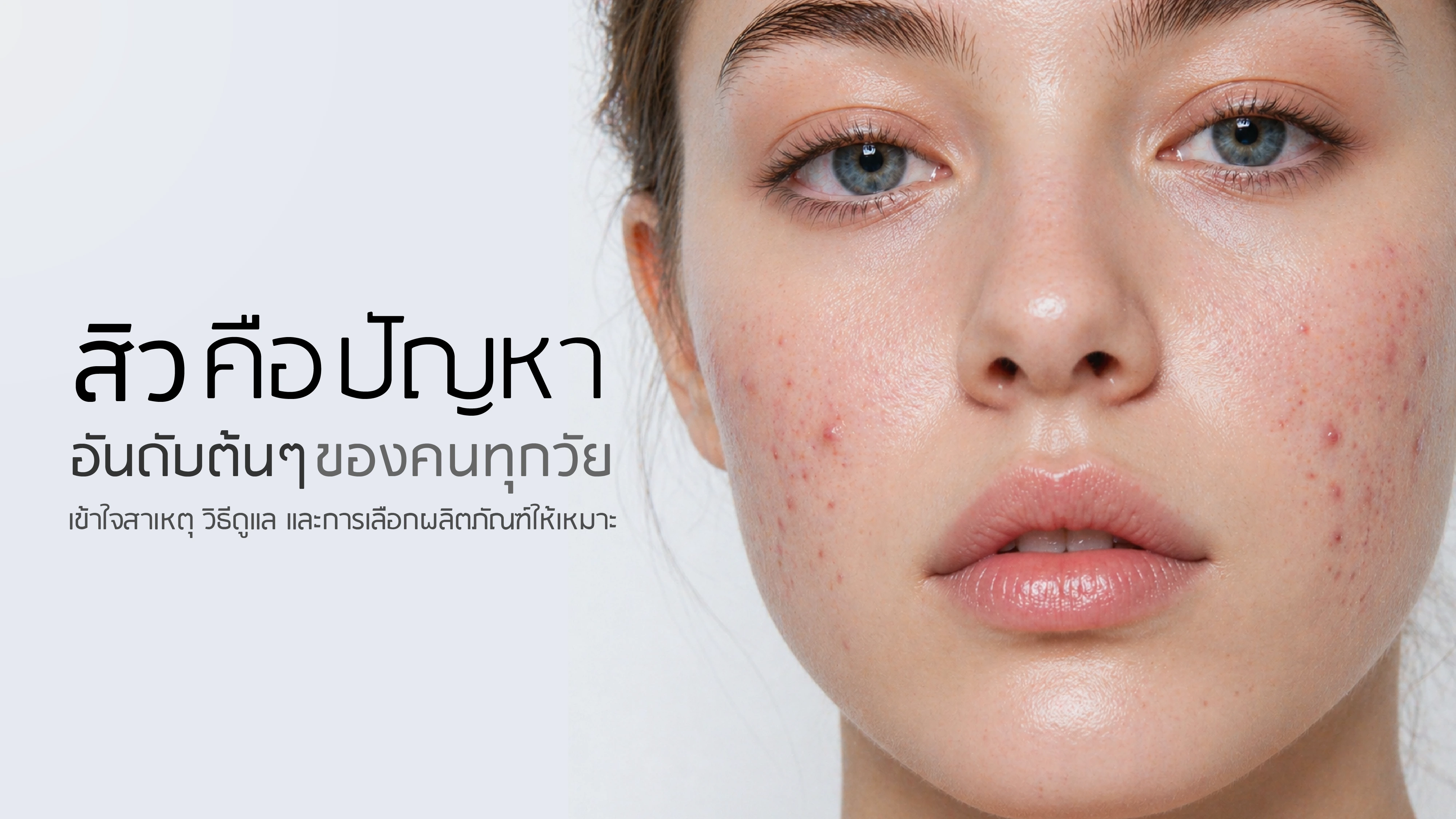 สิว คือ ปัญหาอันดับต้น ๆ ของคนทุกวัย